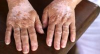 Apa Itu Vitiligo, Penyebab, Gejala dan Cara Pencegahannya
