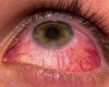 Jenis Penyakit Mata