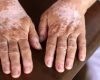 Apa Itu Vitiligo, Penyebab, Gejala dan Cara Pencegahannya