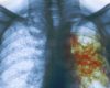 Penyebab dan Gejala penyakit TBC sering terjadi dan bisa menjangkit pernafasan pada manusia? maka Penyebab dan Gejala penyakit TBC perlu kita ketahui
